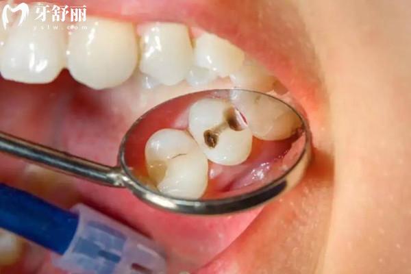 什么是死髓牙 