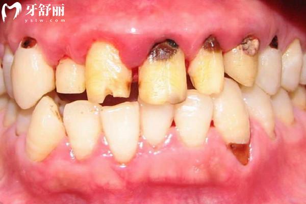 什么是死髓牙 