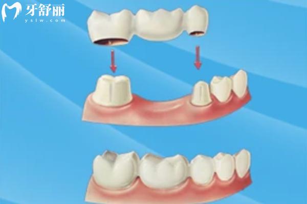 镶牙与种牙有什么区别？