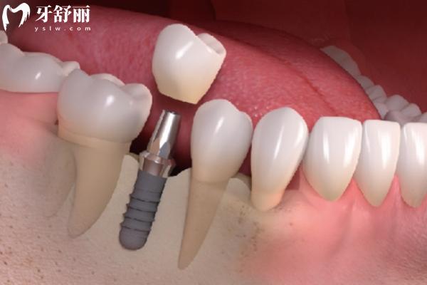 镶牙与种牙有什么区别？