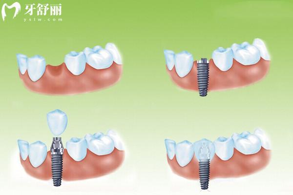 湖州牙科医院一颗种植牙多少钱