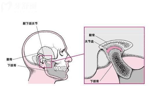 颞下颌关节紊乱能正畸吗？深度解析矫正与颞下颌关节的关系