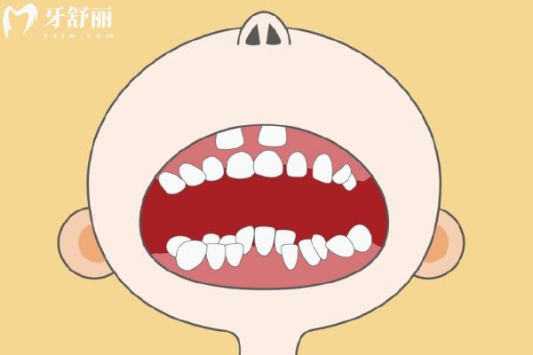 为什么孩子替牙期会出现双排牙？掌握方法及时应对即可