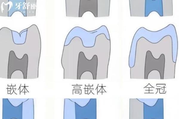 补牙选嵌体和牙冠哪个更好？