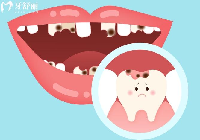 细菌性龋齿是传染病吗