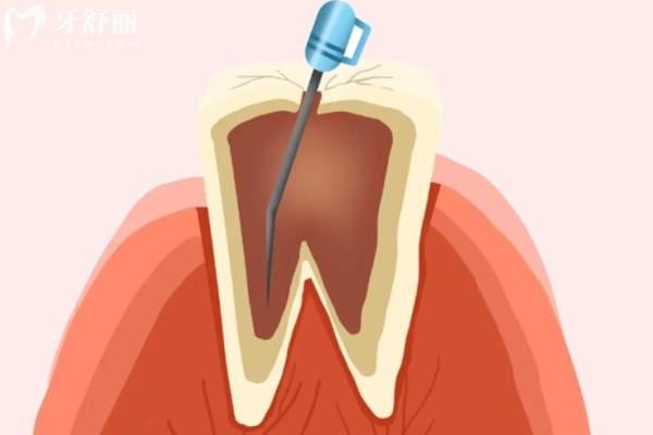 深度解读：牙齿不疼为什么还需要做根管治疗？