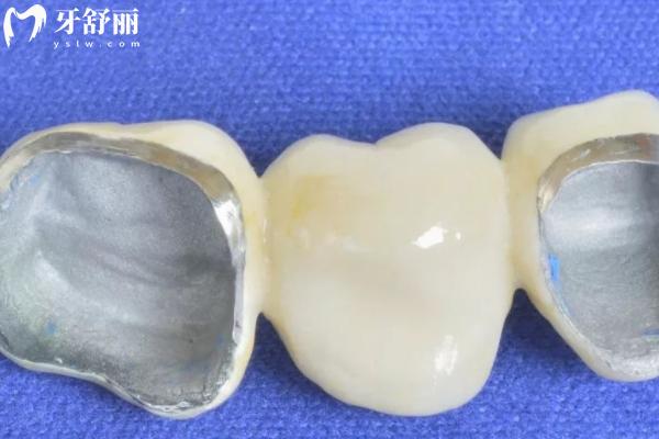 30岁做了满口烤瓷牙能用一辈子吗