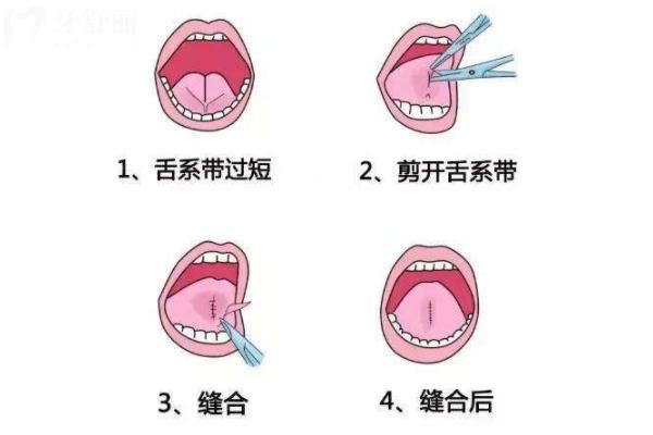 舌系带矫正术
