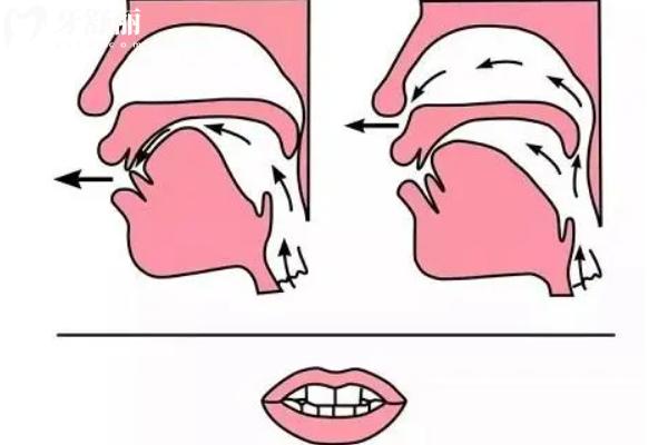 舌系带矫正术