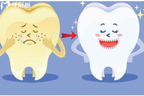 氟斑牙能洗掉吗？