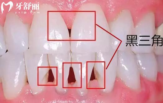 牙齿上的黑三角是怎么回事?可以补救吗?