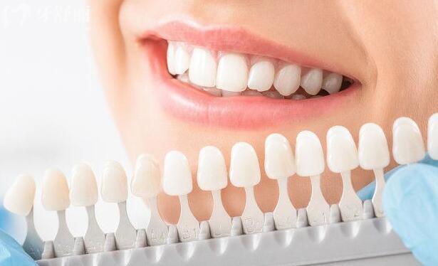 洁白牙齿轻松get，揭秘激光美白牙齿能持续多久？