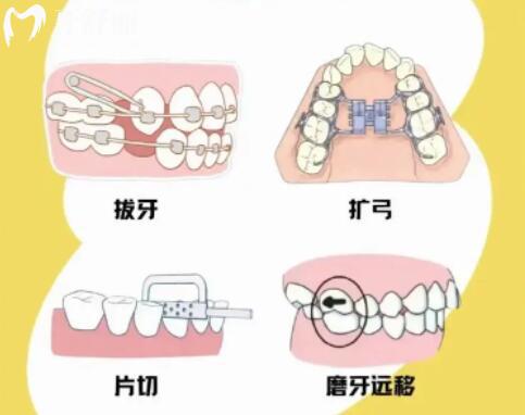 牙齿收缝之后别急着摘牙套，牢固记忆这四项，才能安心脱牙套