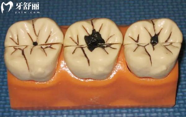 补牙去三 甲医院还是牙科诊所