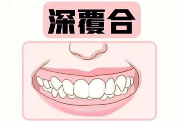 儿童深覆合矫正的必要性