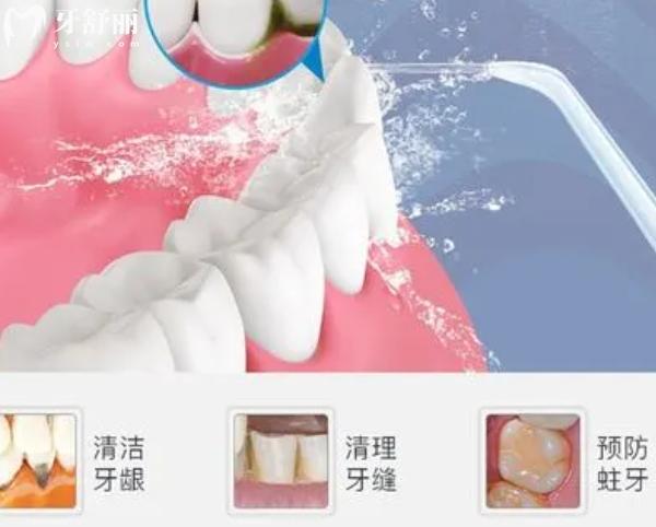 冲牙器是智商税吗？