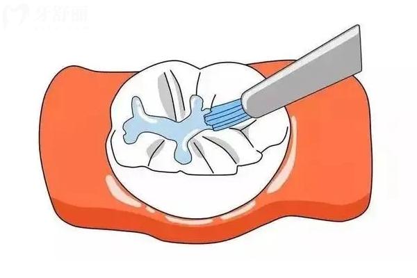 龋齿对全身健康有影响吗？有影响，尽早治疗尽早解决