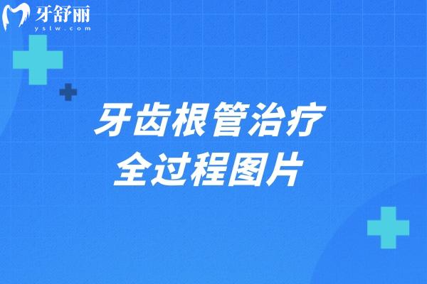 牙齿根管治疗全过程图片