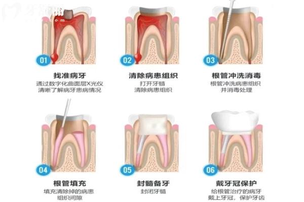 牙齿根管治疗全过程图片