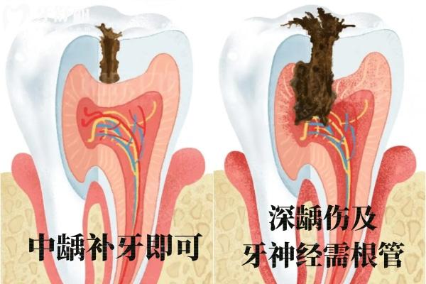 牙齿根管治疗全过程图片