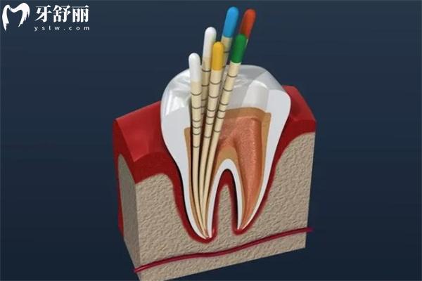 牙齿根管治疗全过程图片