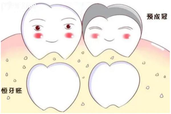 乳牙预成冠作用+分类+适用情况+注意事项  点击查看