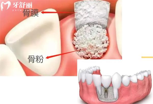 种植牙在什么情况下要用到骨粉和骨膜