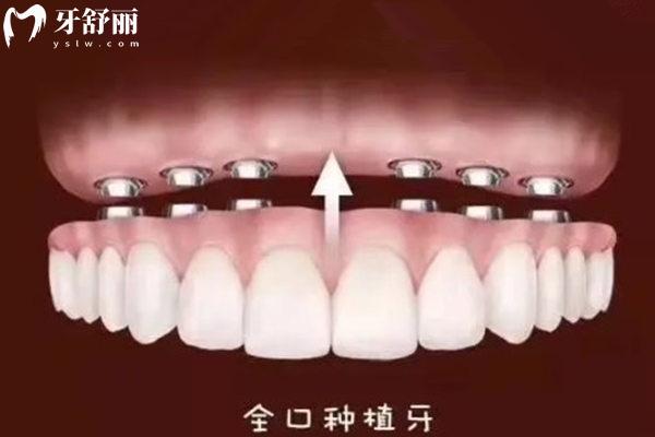 全口种植牙