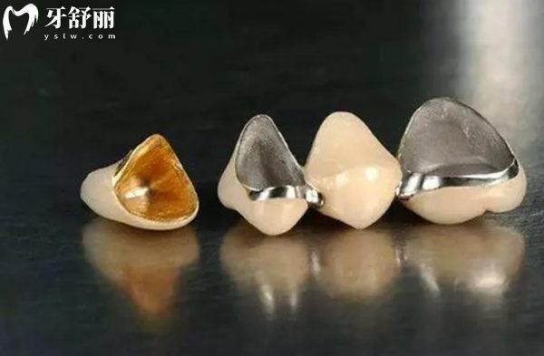 西宁镶烤瓷牙价格多少钱一颗？