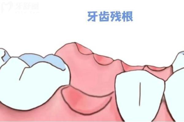 牙齿只剩下残根怎么办？需要拔掉吗该怎么弄