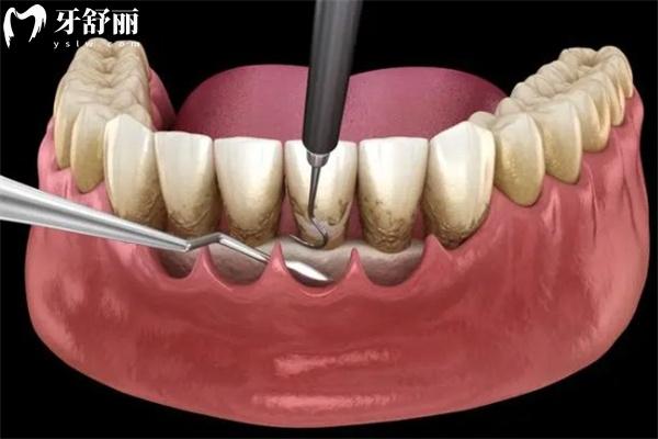牙龈刮治费用大概多少钱?