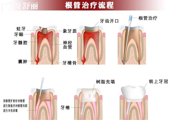 根管治疗为啥前牙和后牙的价格不一样？