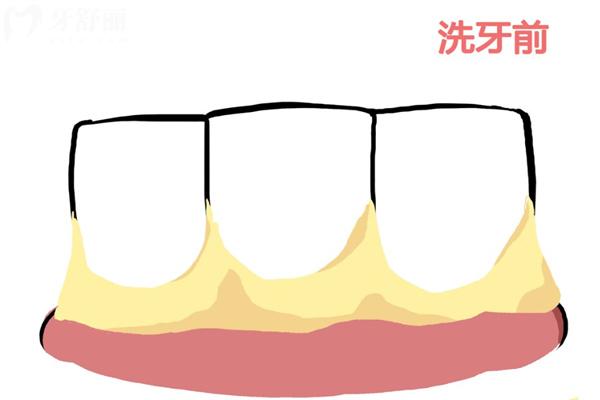 多久洗牙一次比较好