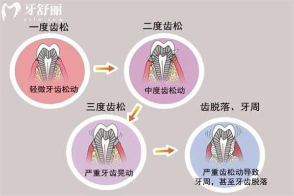 分享牙松动等级的分类方法及松动牙齿怎么处理的办法