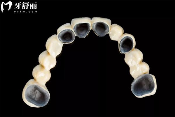 假牙哪种材质便宜还实用?这四大假牙类型及其适用人群和价格参考下