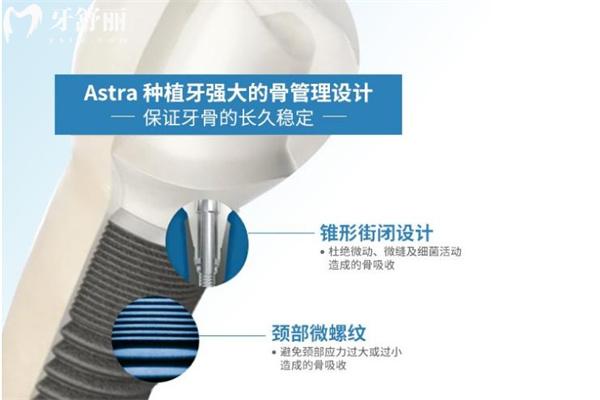 2025新出的国内种植牙价格一览表:包含集采种植牙全口/单颗多少钱