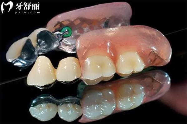 全口假牙是怎么固定的