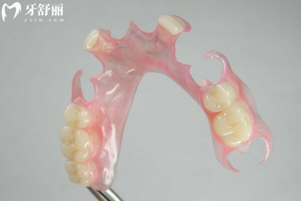无挂钩镶牙是怎么回事?无挂钩镶牙原理、价格与利弊全解析
