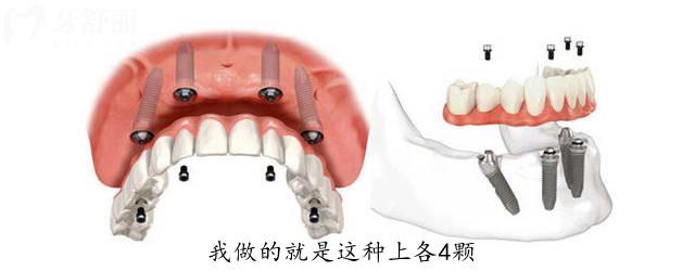 【2025年价目表】福州口腔医院收费标准在这！种牙