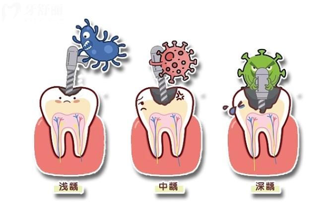 牙齿龋坏六种洞型怎么进行治疗