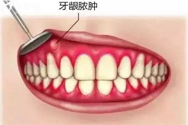 口腔内壁小肉球怎么回事