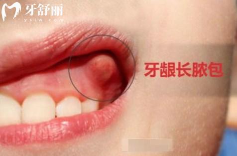 口腔内壁小肉球怎么回事