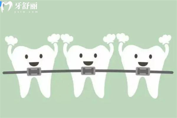 牙齿矫正全攻略：从年龄选择到矫正器类型