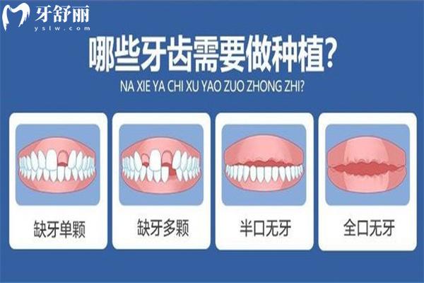 国内种植牙收费价目表