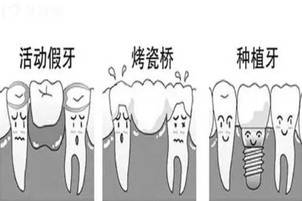 活动假牙种类和价格