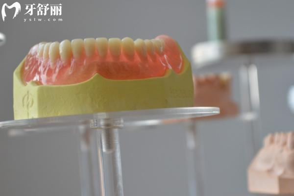 活动假牙种类和价格