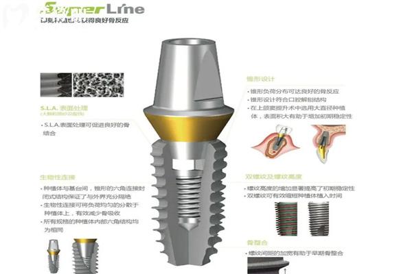 种牙什么牌子的性价比高?2025年国内十大流行种植牙品牌排行榜来了解下