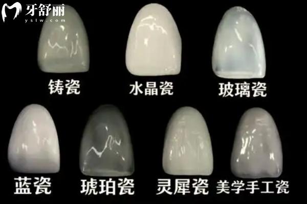 蓝瓷贴面vs琥珀瓷贴面哪个好