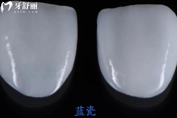 蓝瓷贴面vs琥珀瓷贴面哪个好