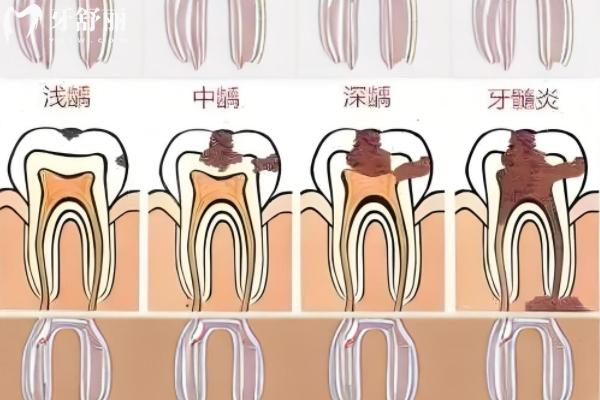2025惠州补牙多少钱一颗？